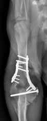 Fracture Coude COUDE POSTOP 238.jpg
