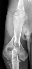 Fracture Coude COUDE PREOP 238.jpg