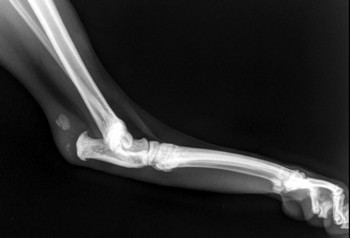 TENDON ACHILLE PREOP350.jpg