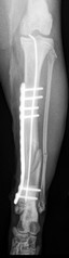 TIBIA POSTOP F 238.jpg