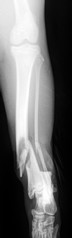 TIBIA PREOP F S0 I0 238.jpg