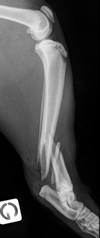 TIBIA PREOP P S0 I0 238.jpg